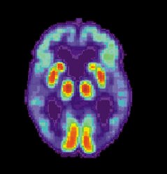 Obraz mózgu chorego na chorobę Alzheimera